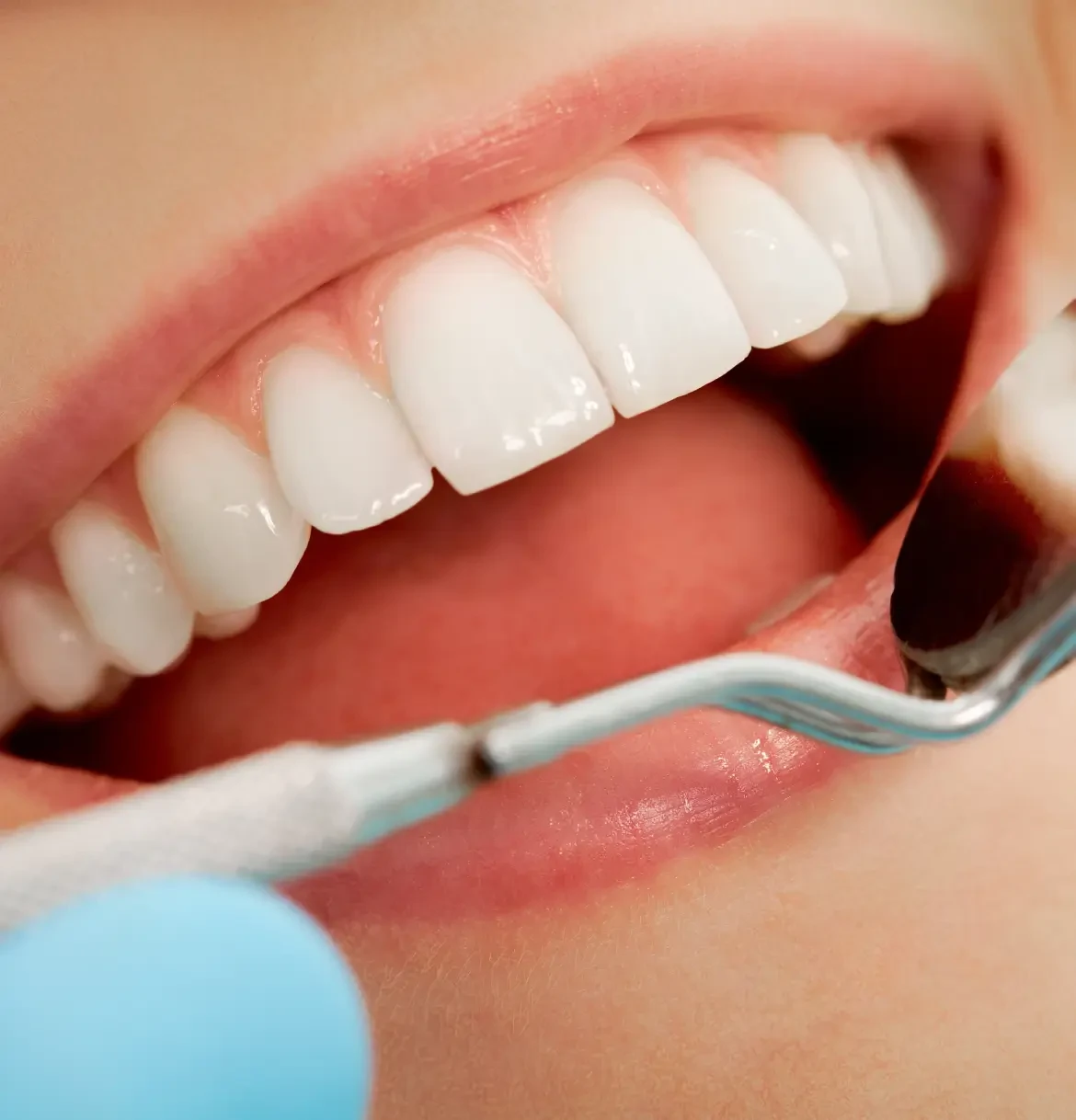 Изображение Чем отличается профессиональное отбеливание от домашних средств: советы стоматолога